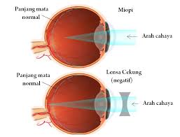 Detail Gambar Cacat Mata Nomer 28