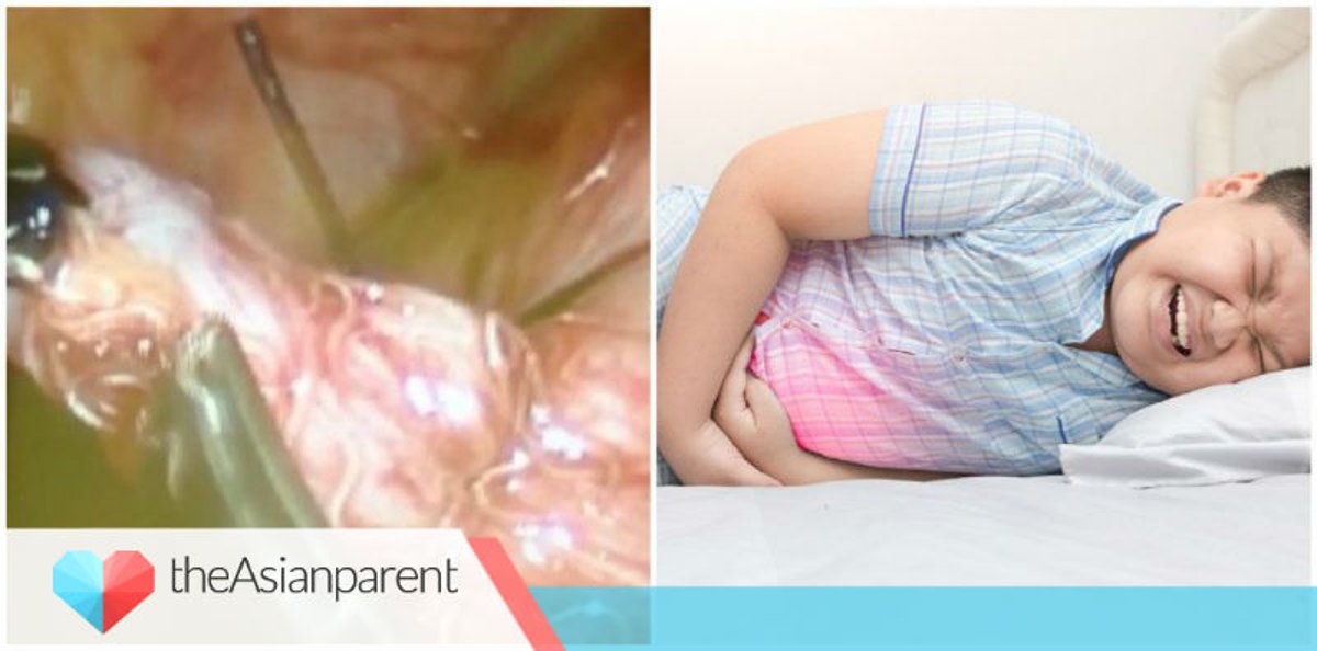 Detail Gambar Cacing Perut Pada Anak Cacing Perut Nomer 30