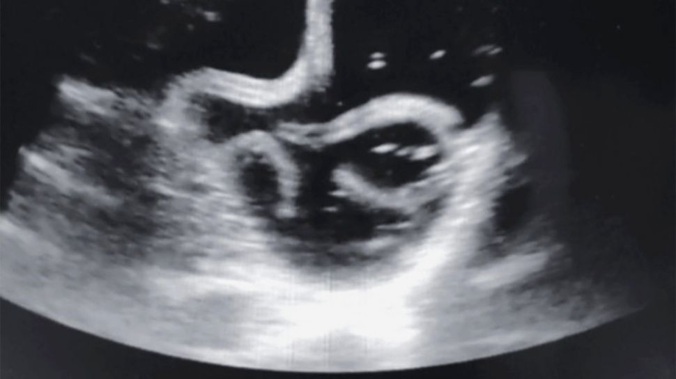 Detail Gambar Cacing Perut Pada Anak Cacing Perut Nomer 41
