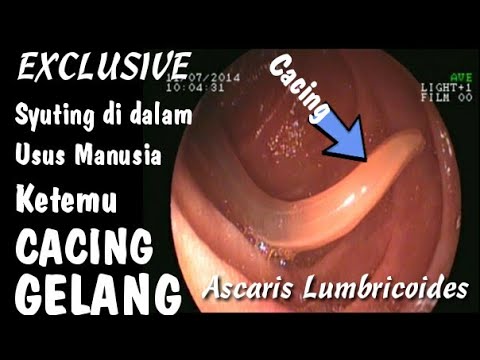 Detail Gambar Cacing Perut Pada Anak Cacing Perut Nomer 44