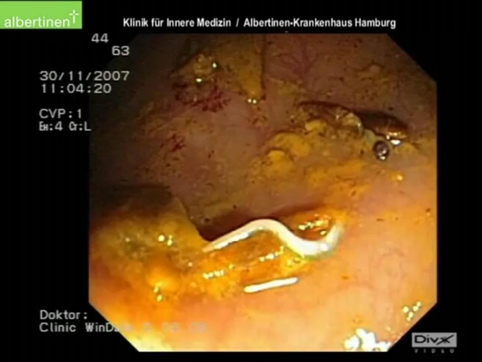 Detail Gambar Cacing Perut Pada Anak Jajam Anak Sekolah Nomer 10