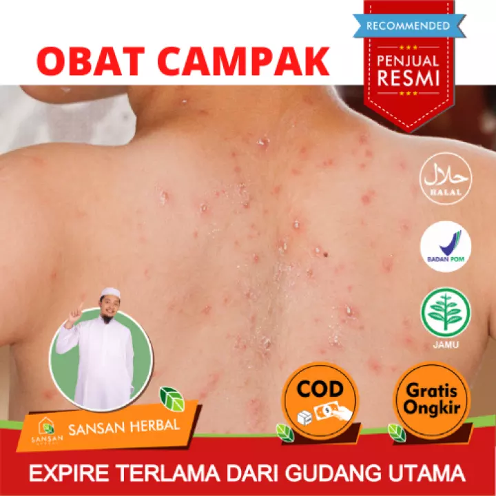 Detail Gambar Campak Dan Cacar Air Nomer 51