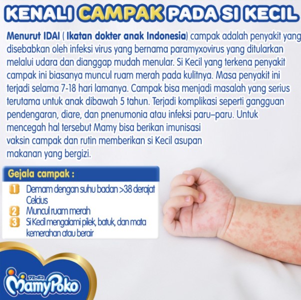 Detail Gambar Campak Pada Anak Nomer 25