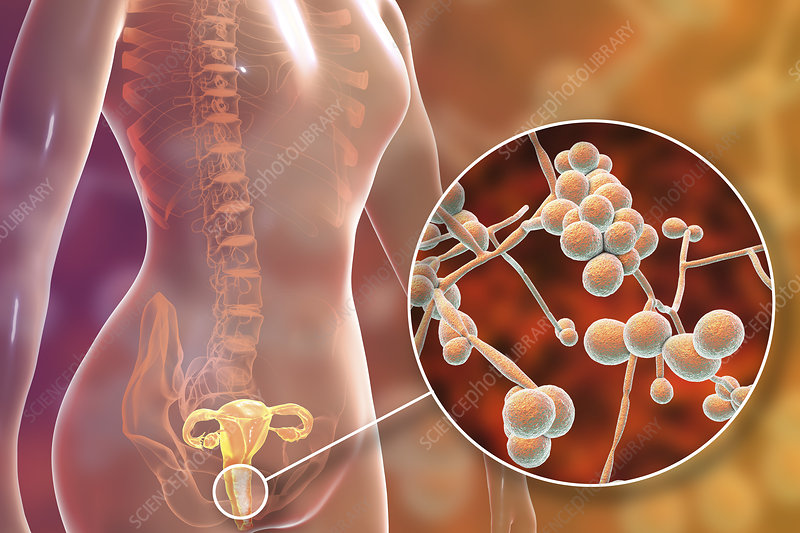 Detail Gambar Candida Albicans Nomer 39