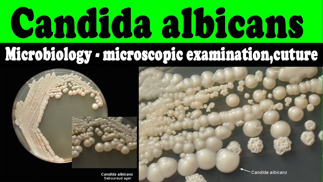 Detail Gambar Candida Albicans Nomer 42