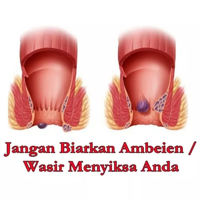 Detail Contoh Ambeien Ringan Nomer 11