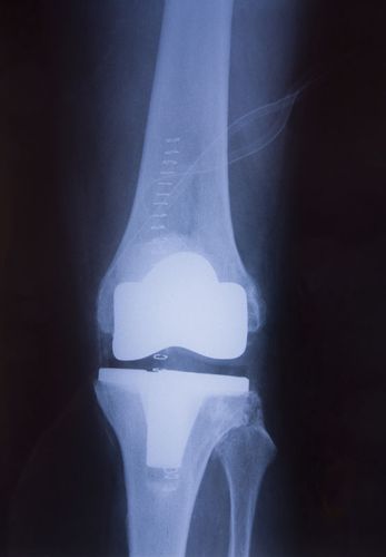 Detail Gambar Cedera Lutut Nomer 29