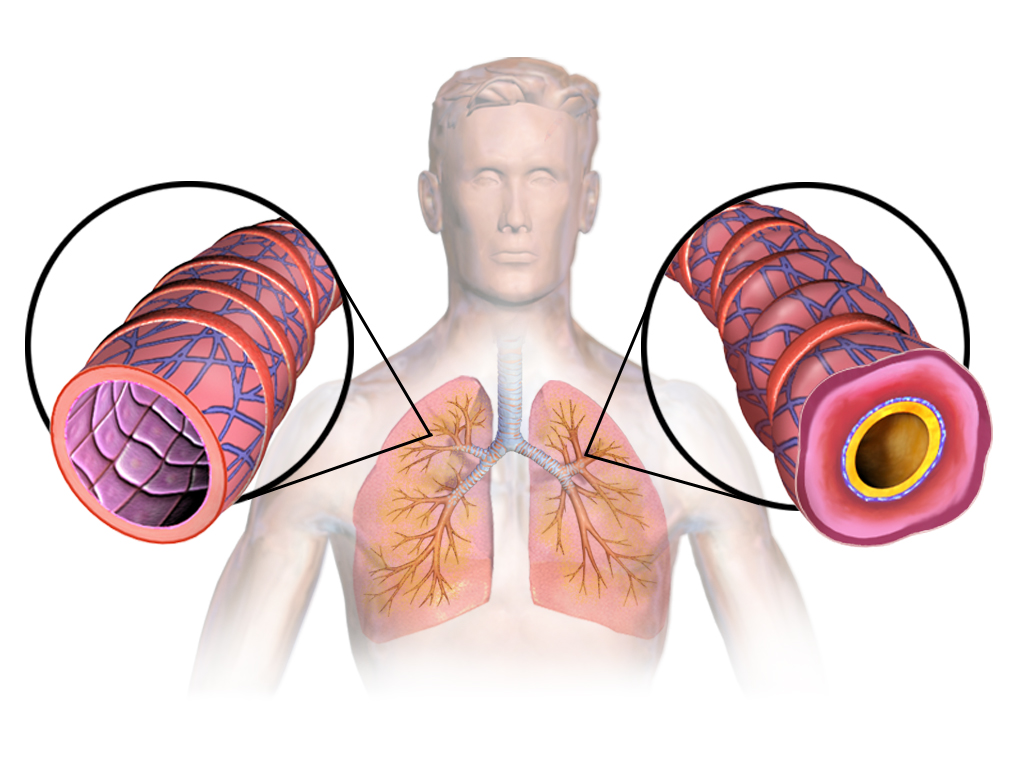 Asthma Bronchiale Bilder - KibrisPDR