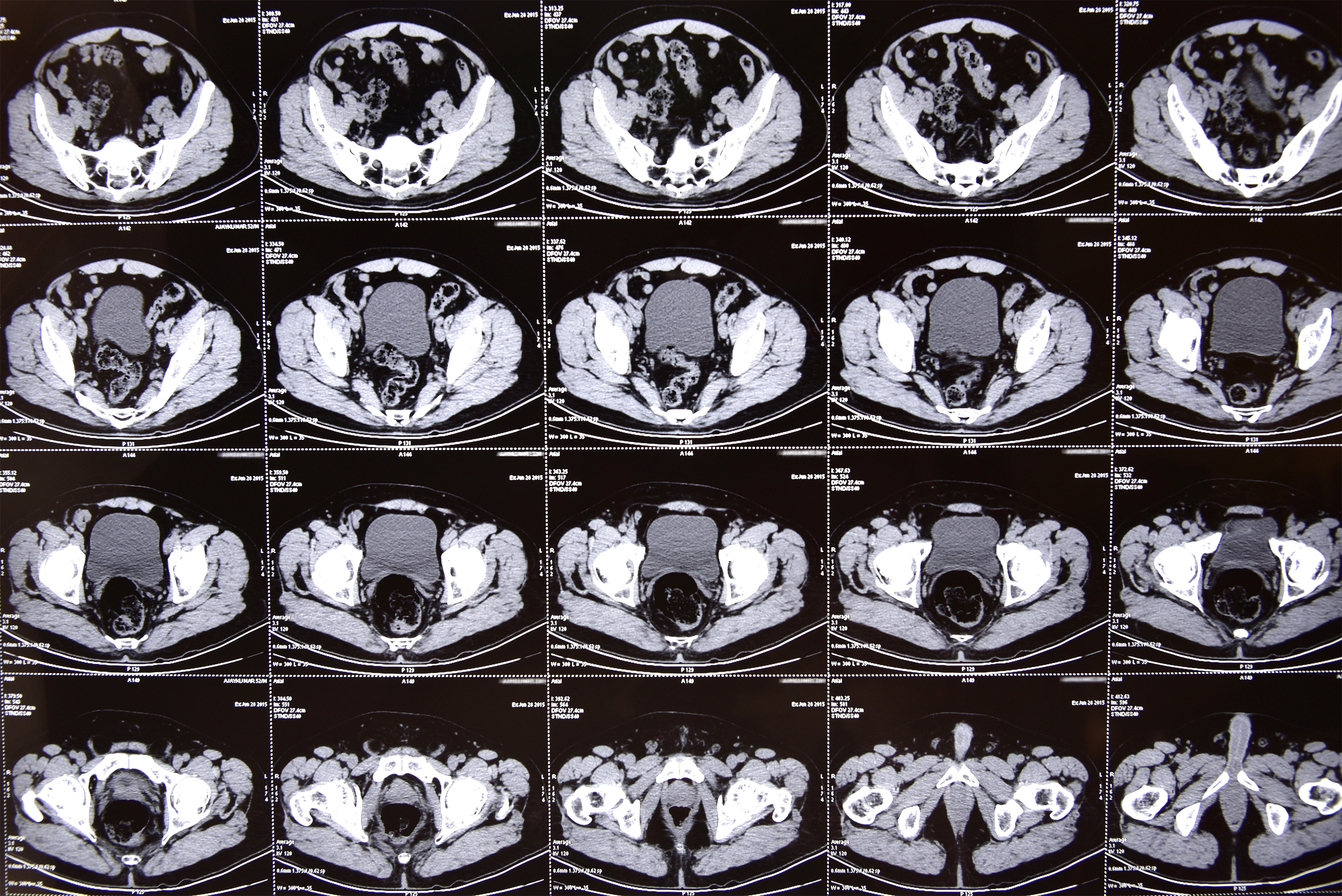 Detail Gambar Ct Scan Nomer 54