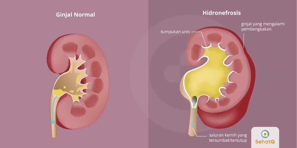 Detail Gambar Definisi Ginjal Pada Ibu Hamil Nomer 15