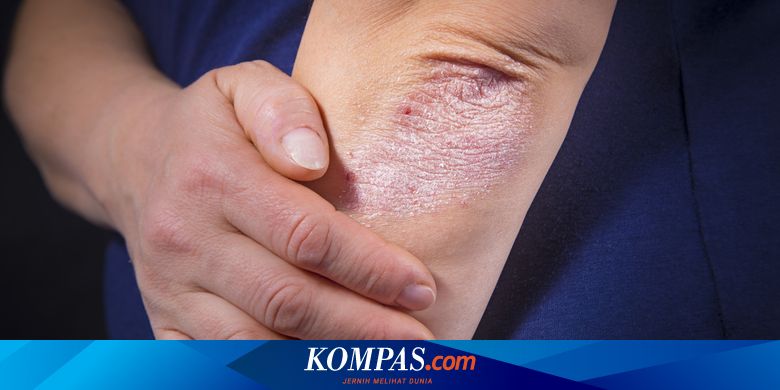 Detail Contoh Bintik Putih Pada Kulit Nomer 17