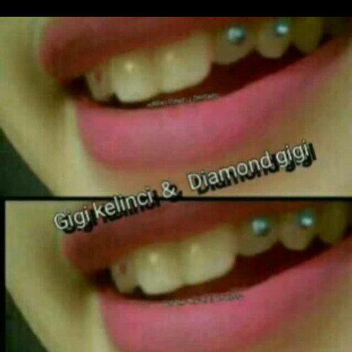 Detail Gambar Diamond Gigi Nomer 26