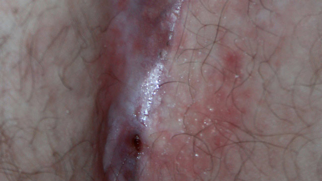 Gambar Disease In Pns - KibrisPDR