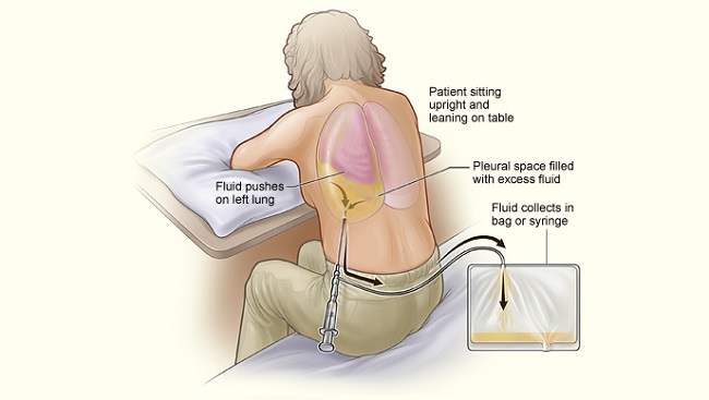 Detail Gambar Effusi Pleura Nomer 11