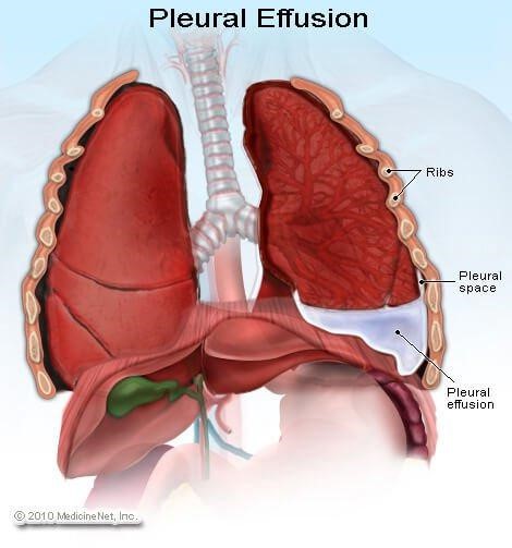 Detail Gambar Effusi Pleura Nomer 3