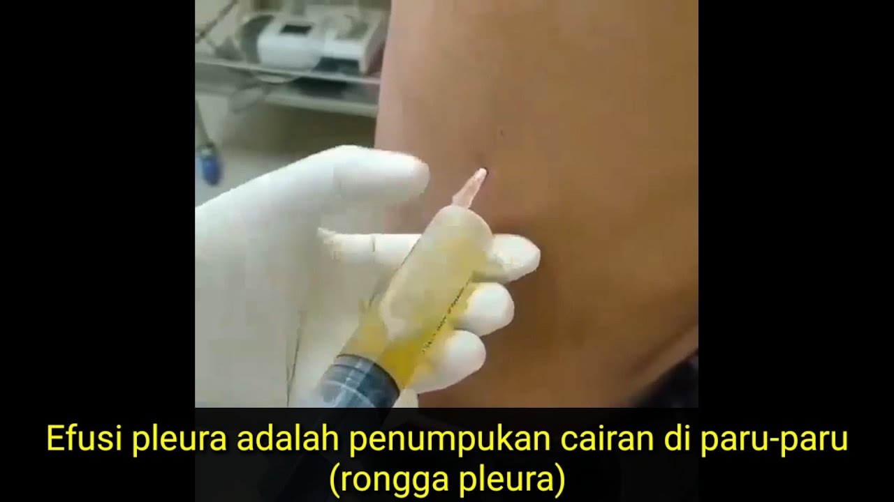 Detail Gambar Effusi Pleura Nomer 20