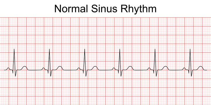 Detail Gambar Ekg Normal Nomer 8