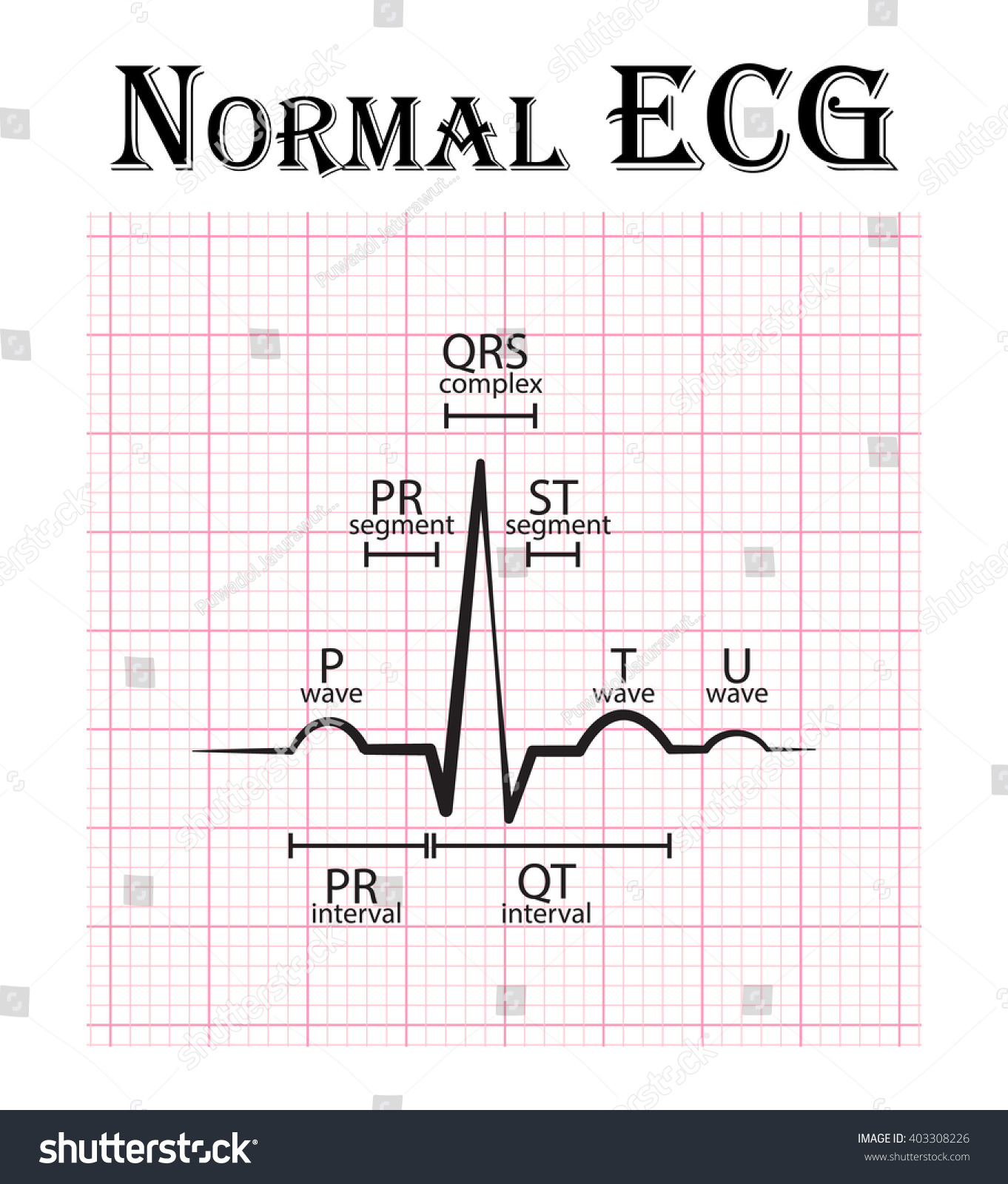 Detail Gambar Ekg Normal Nomer 9