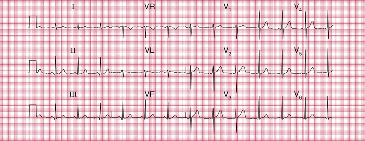 Detail Gambar Ekg Normal 12 Lead Nomer 13