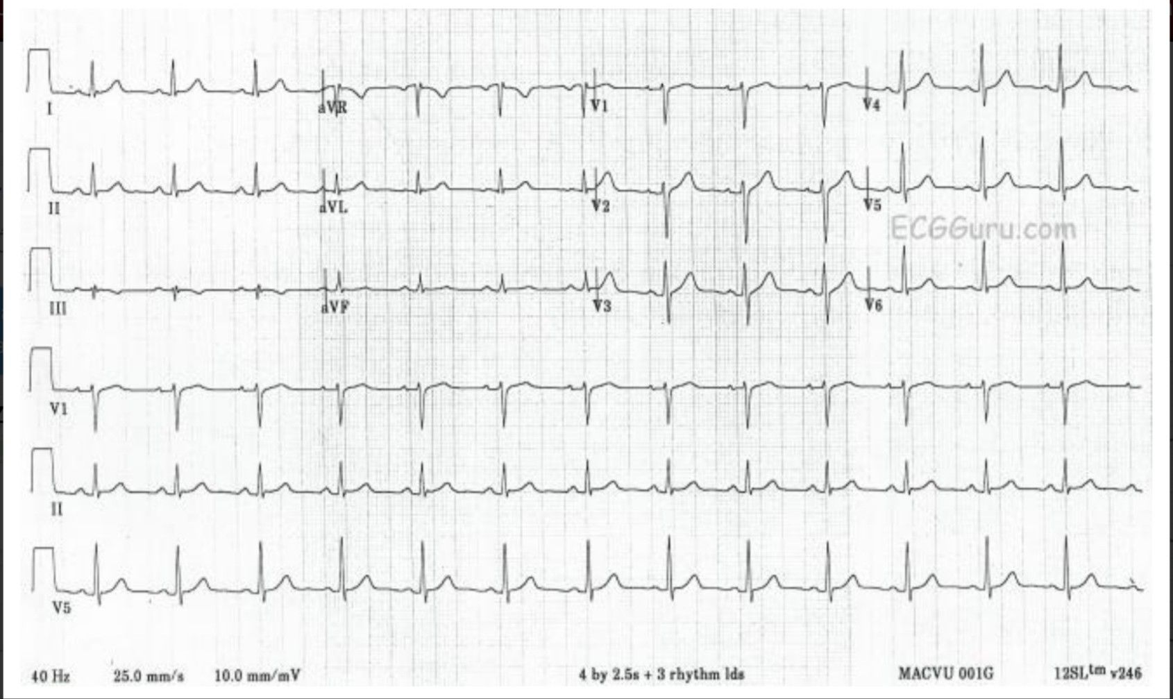 Detail Gambar Ekg Normal 12 Lead Nomer 14