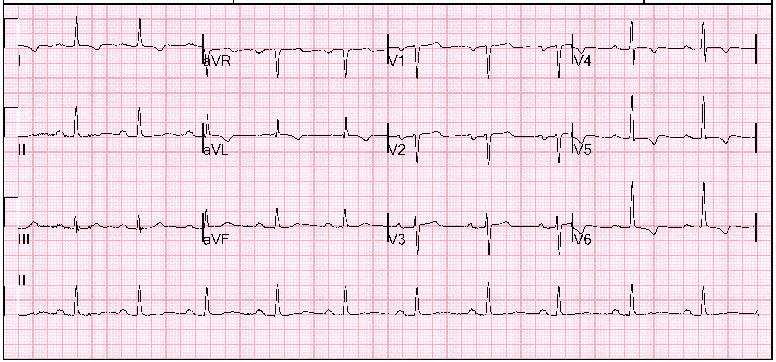 Detail Gambar Ekg Normal 12 Lead Nomer 17