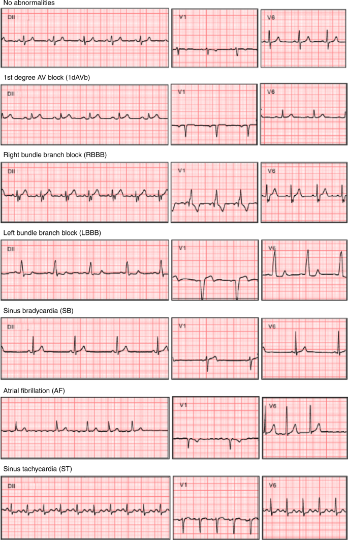 Detail Gambar Ekg Normal 12 Lead Nomer 19