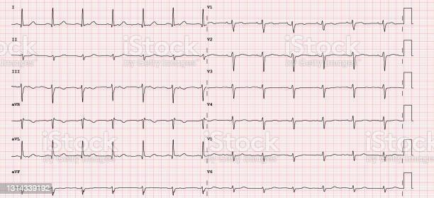 Detail Gambar Ekg Normal 12 Lead Nomer 2