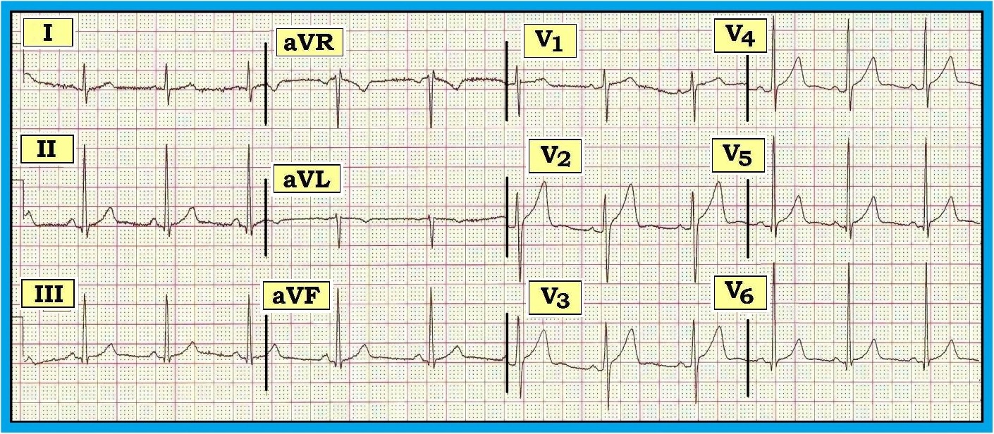 Detail Gambar Ekg Normal 12 Lead Nomer 20