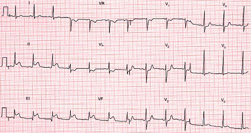 Detail Gambar Ekg Normal 12 Lead Nomer 23