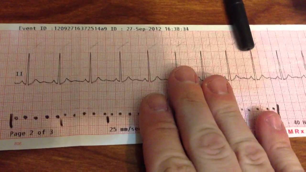 Detail Gambar Ekg Normal 12 Lead Nomer 25