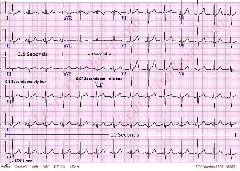 Detail Gambar Ekg Normal 12 Lead Nomer 28