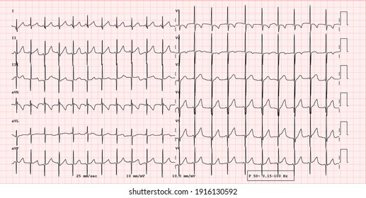 Detail Gambar Ekg Normal 12 Lead Nomer 34