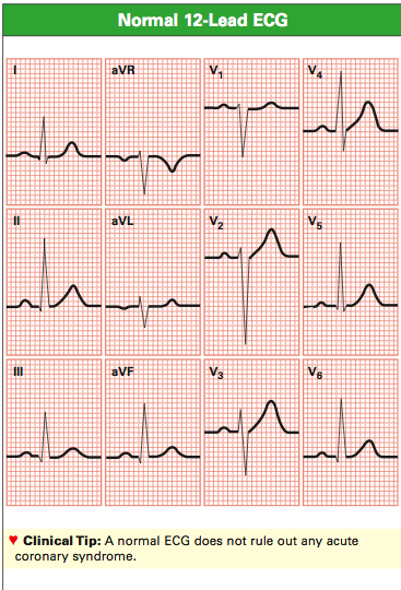 Detail Gambar Ekg Normal 12 Lead Nomer 3