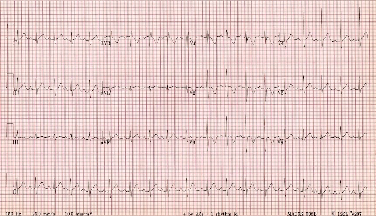 Detail Gambar Ekg Normal Nomer 12