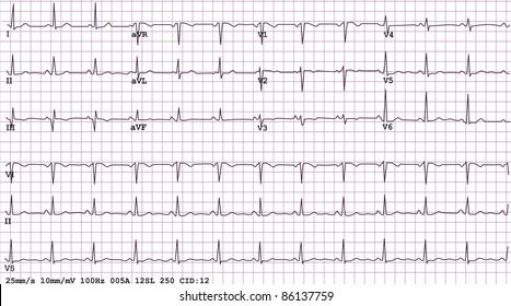 Detail Gambar Ekg Normal Nomer 13