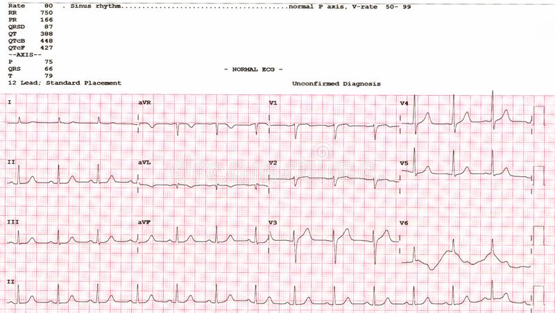 Detail Gambar Ekg Normal Nomer 21