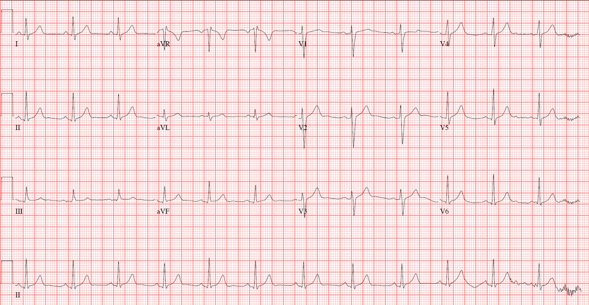 Detail Gambar Ekg Normal Nomer 25