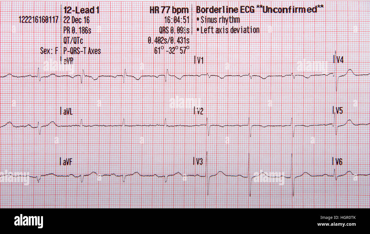 Detail Gambar Ekg Normal Nomer 27