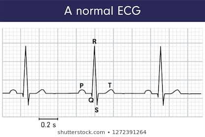 Detail Gambar Ekg Normal Nomer 28