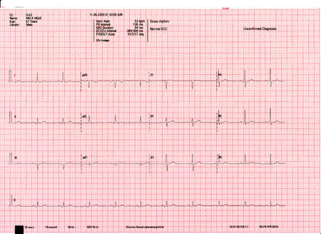 Detail Gambar Ekg Normal Nomer 30