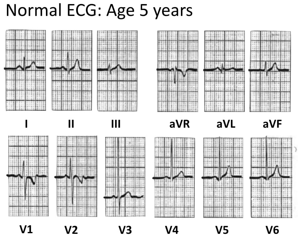 Detail Gambar Ekg Normal Nomer 33