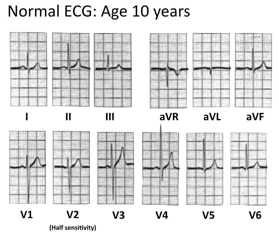 Detail Gambar Ekg Normal Nomer 34