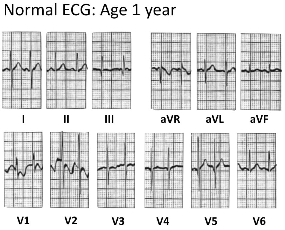 Detail Gambar Ekg Normal Nomer 36