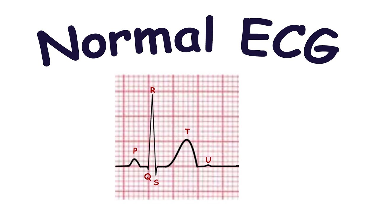 Detail Gambar Ekg Normal Nomer 4