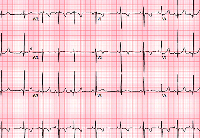 Detail Gambar Ekg Normal Nomer 37