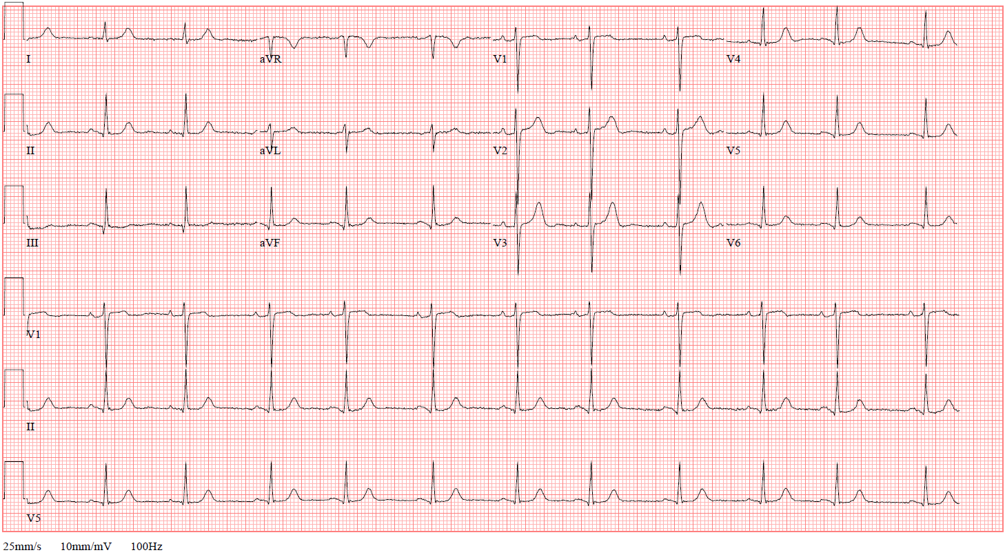 Detail Gambar Ekg Normal Nomer 5