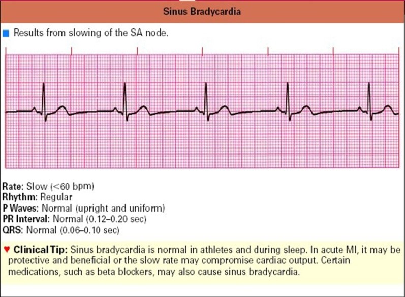 Detail Gambar Ekg Sinus Bradikardi Nomer 6