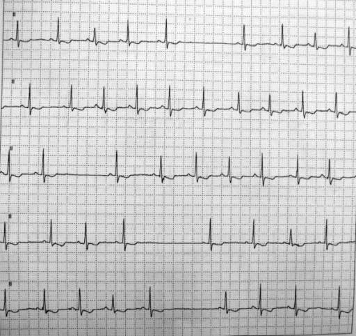 Detail Gambar Ekg Sinus Bradikardi Nomer 8