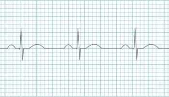 Detail Gambar Ekg Sinus Bradikardi Nomer 11