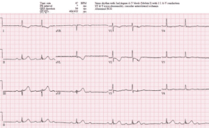 Detail Gambar Ekg Sinus Bradikardi Nomer 12